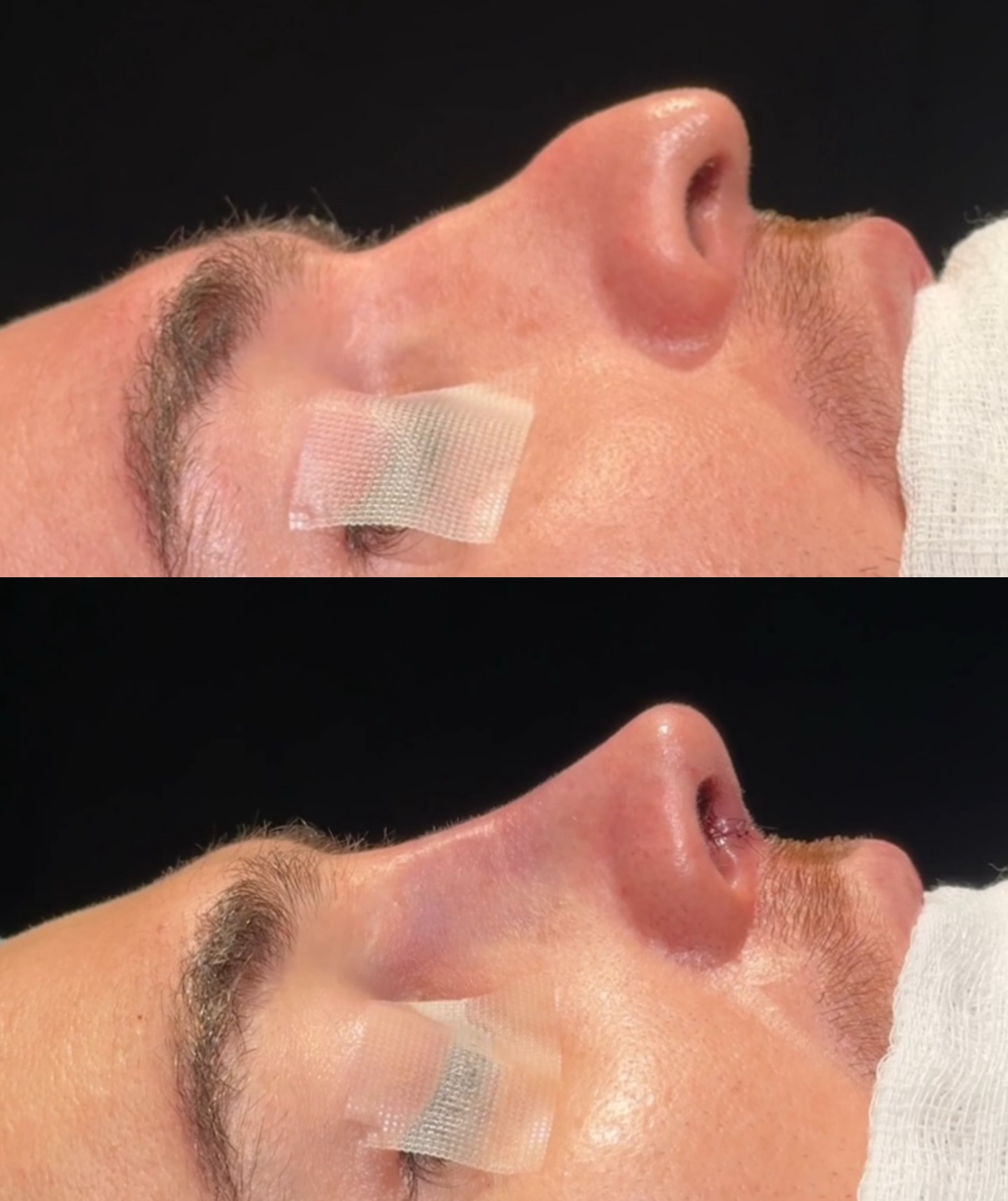 Rinoplastia — resultado antes e depois 1