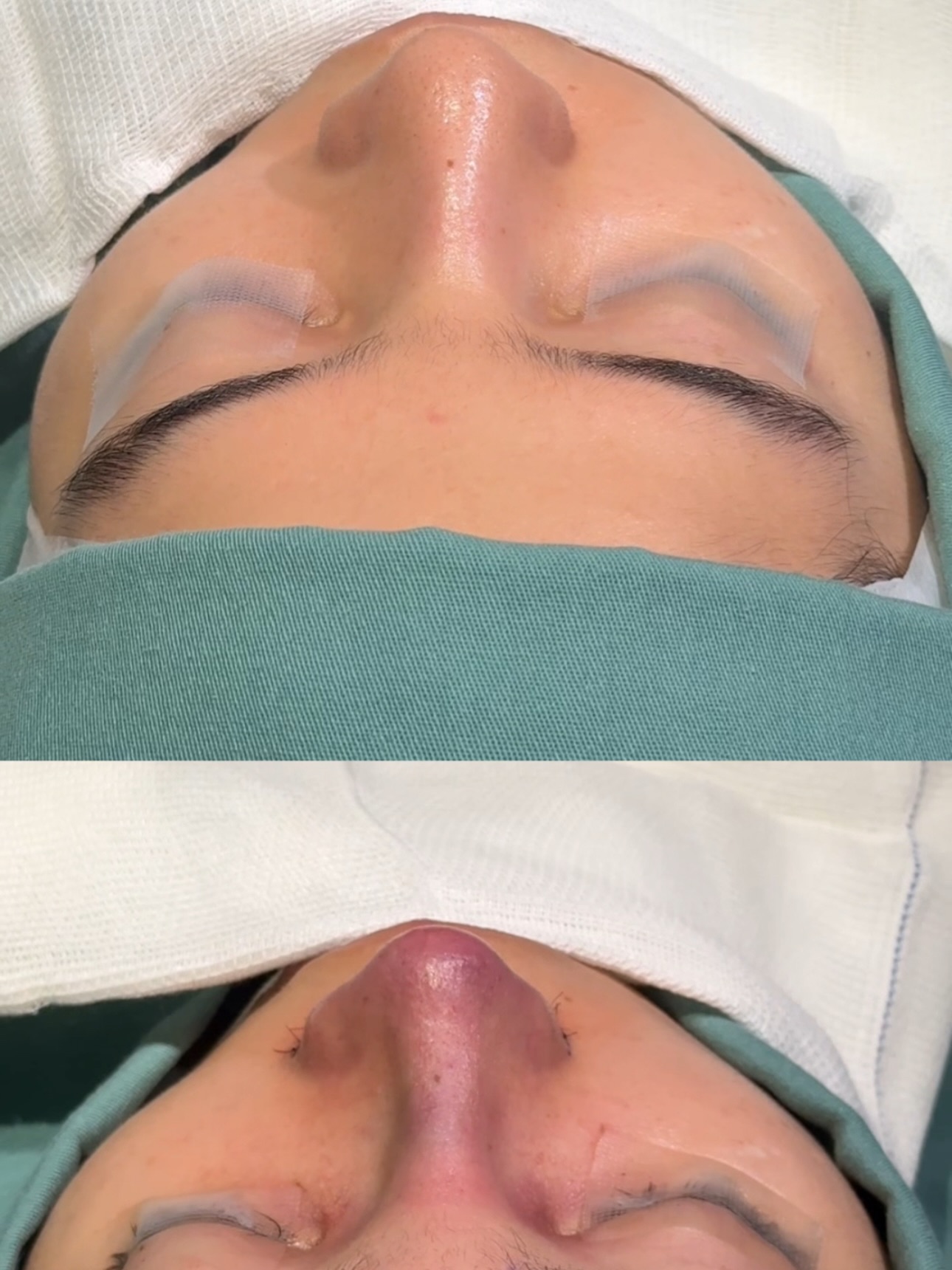 Rinoplastia — resultado antes e depois 5