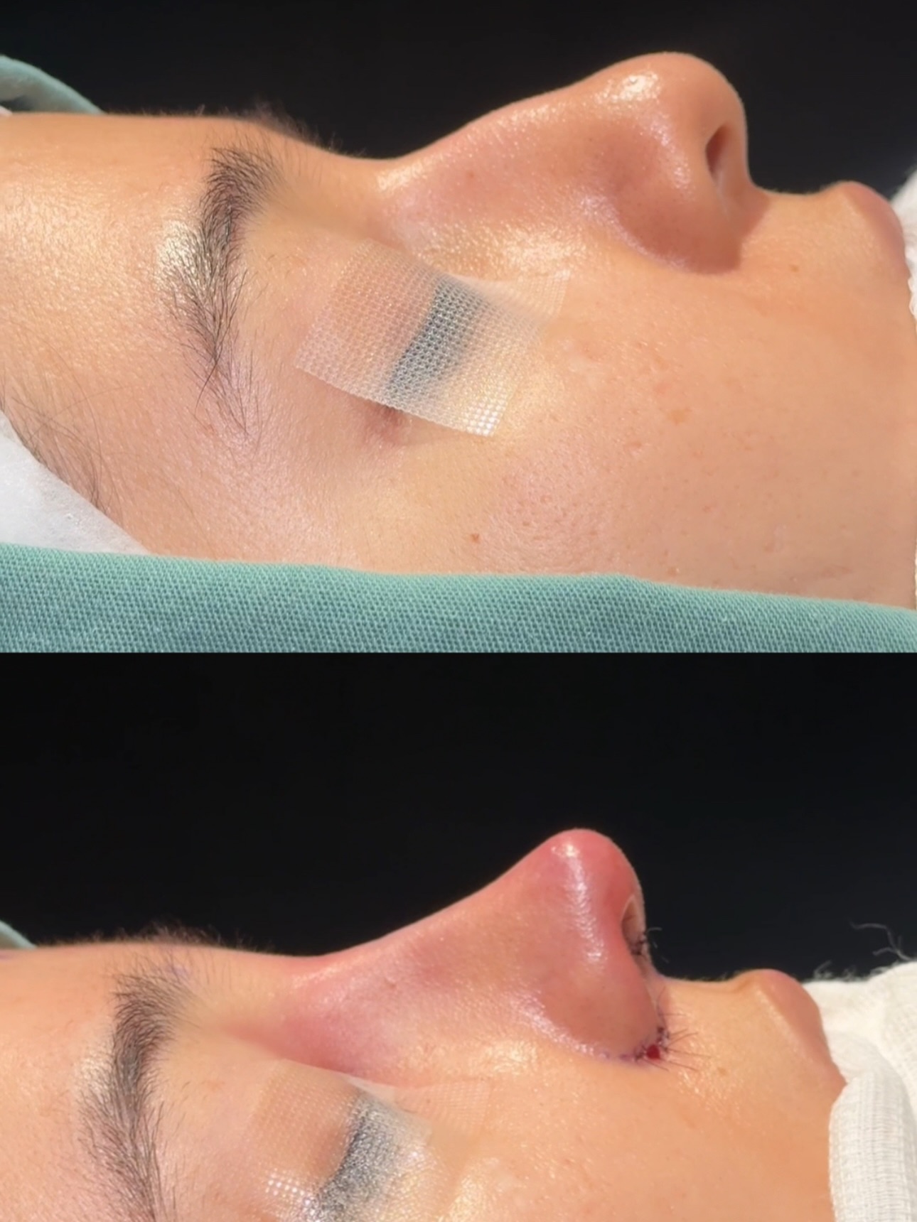 Rinoplastia — resultado antes e depois 2