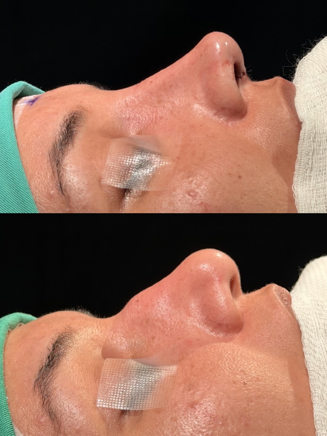 Rinoplastia — resultado antes e depois 6