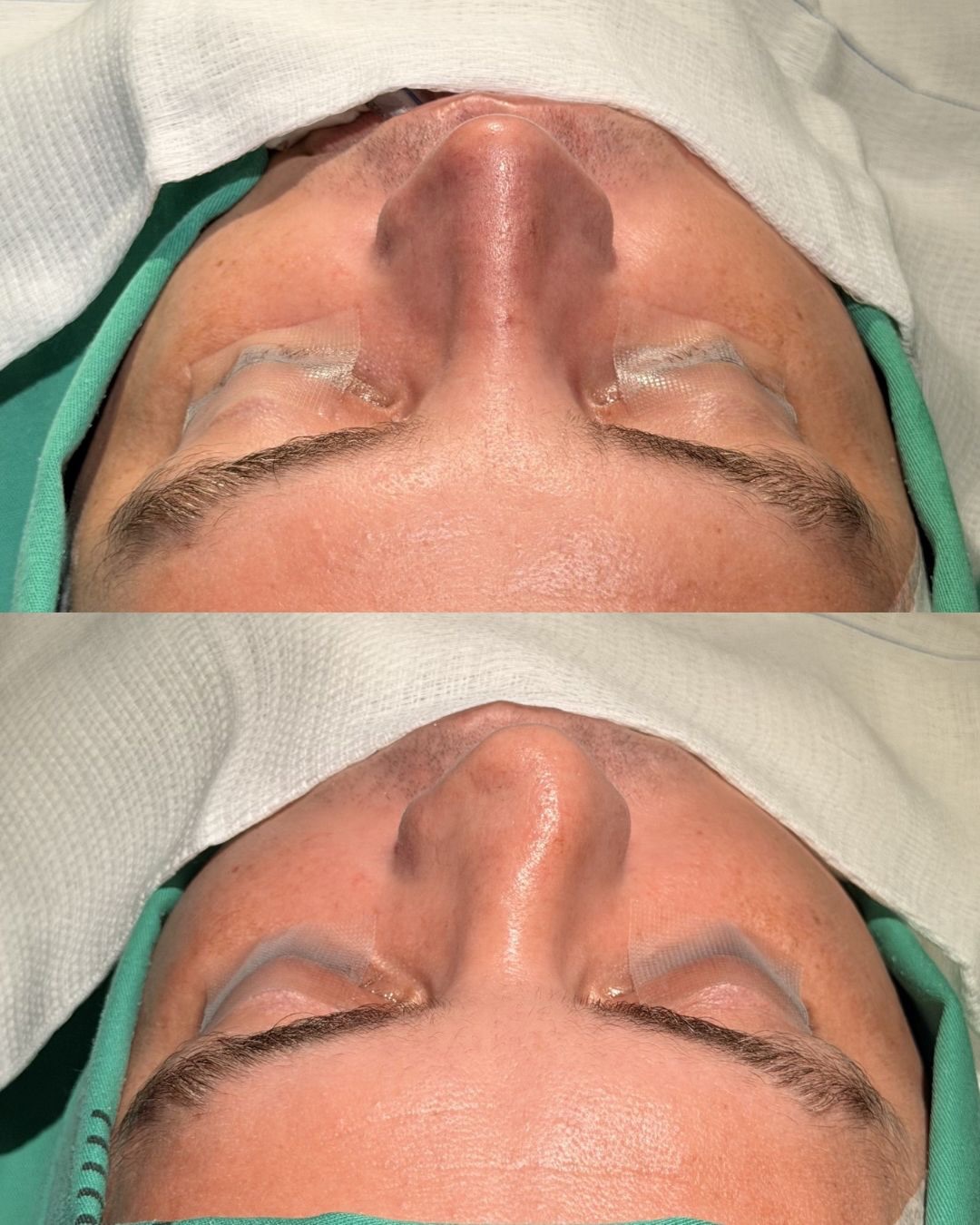Rinoplastia — resultado antes e depois 4