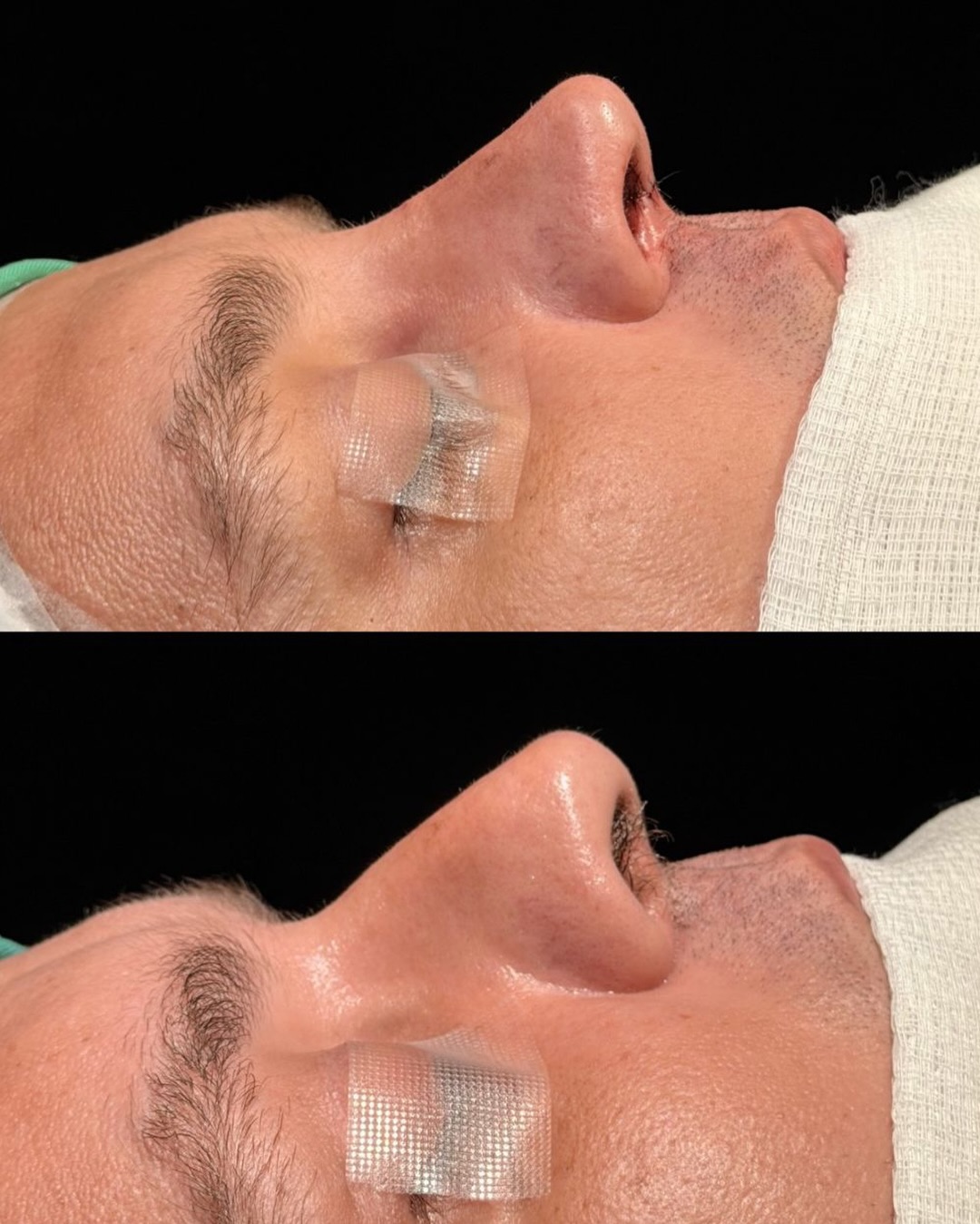 Rinoplastia — resultado antes e depois 3